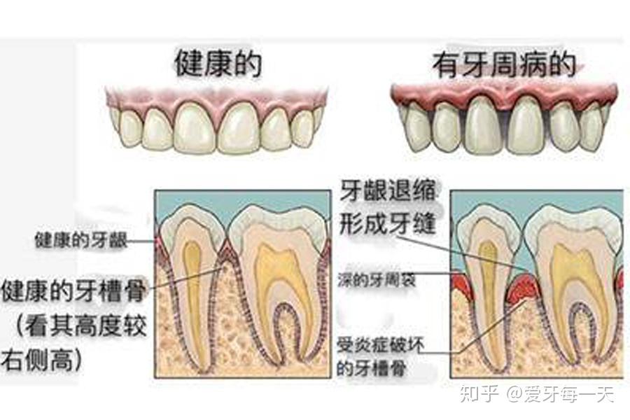 洗牙不会让牙缝变大牙缝变大的真正原因是牙龈牙周病变