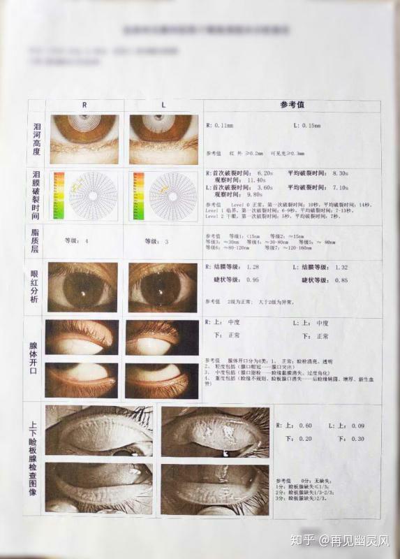 干眼症患者想要看病少花钱得先看懂这个