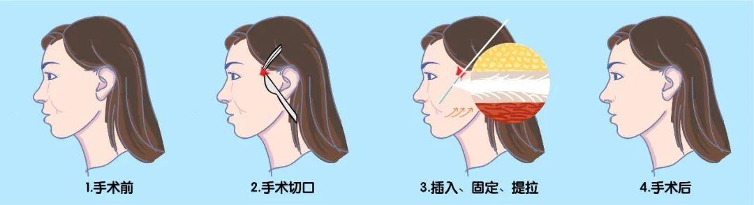 線雕的線pdoppdoplla有啥區別為什麼這麼多人想做線雕提升