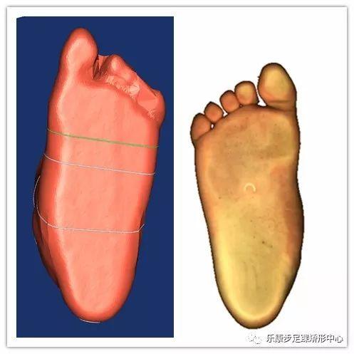 扁平足 足外翻 副舟骨的联系 区别以及临床矫正方式 矫正鞋临床矫治效果前后对比 知乎
