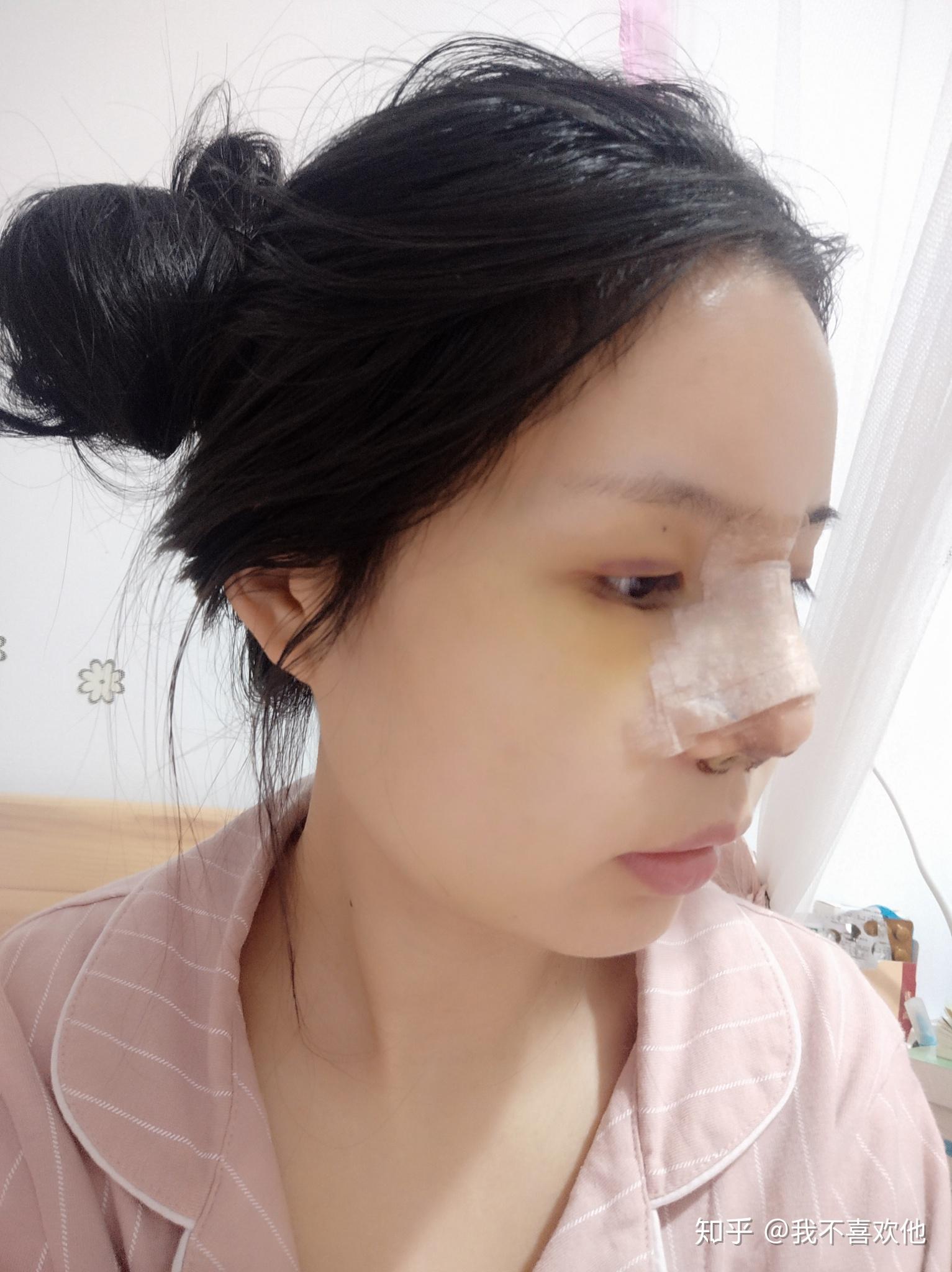 27岁“塌鼻子”女孩奔赴北京，做完鼻整形后5个月，真人案例告诉你这些“弯路”不要走！ - 知乎