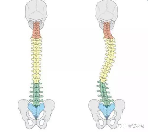 脊柱侧弯50问(很全的问题汇总)——北京大学第一医院脊柱外科王宇科普系列 - 知乎