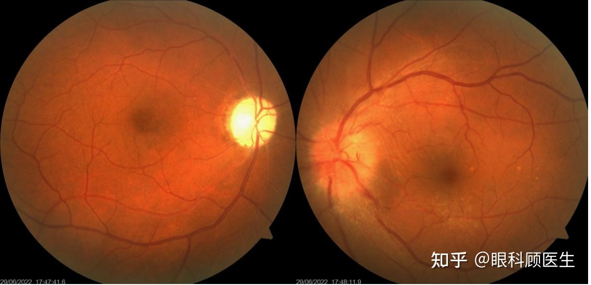 视力减退,眼球突出,慢性视乳头水肿或萎缩,视神经睫状静脉称为脑膜瘤