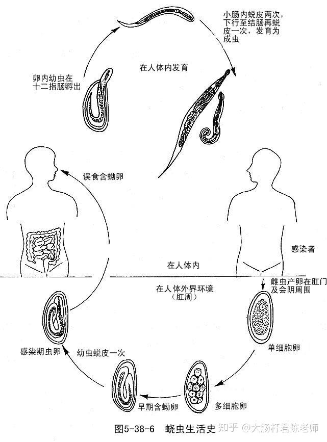 蛲虫异位寄生图片