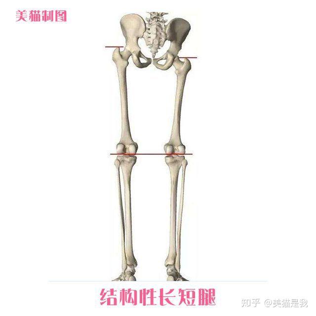 你走路姿势难看可能是长短腿导致该如何辨别与矫正