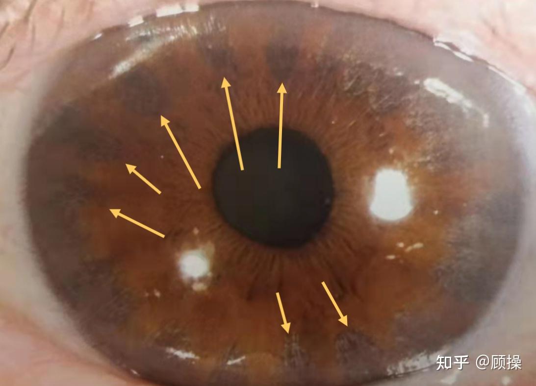 急性闭角型青光眼该如何治疗