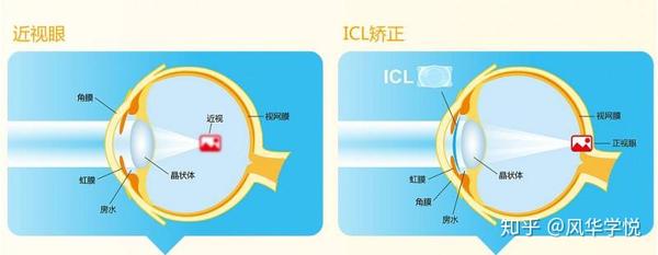 Icl晶体植入手术22大疑问全解答 知乎