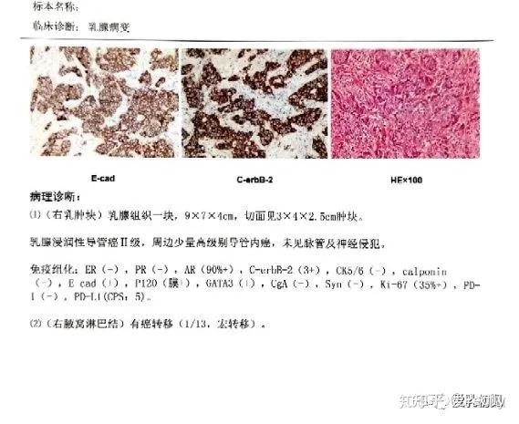 病理報告這些指標提示乳腺癌預後良好