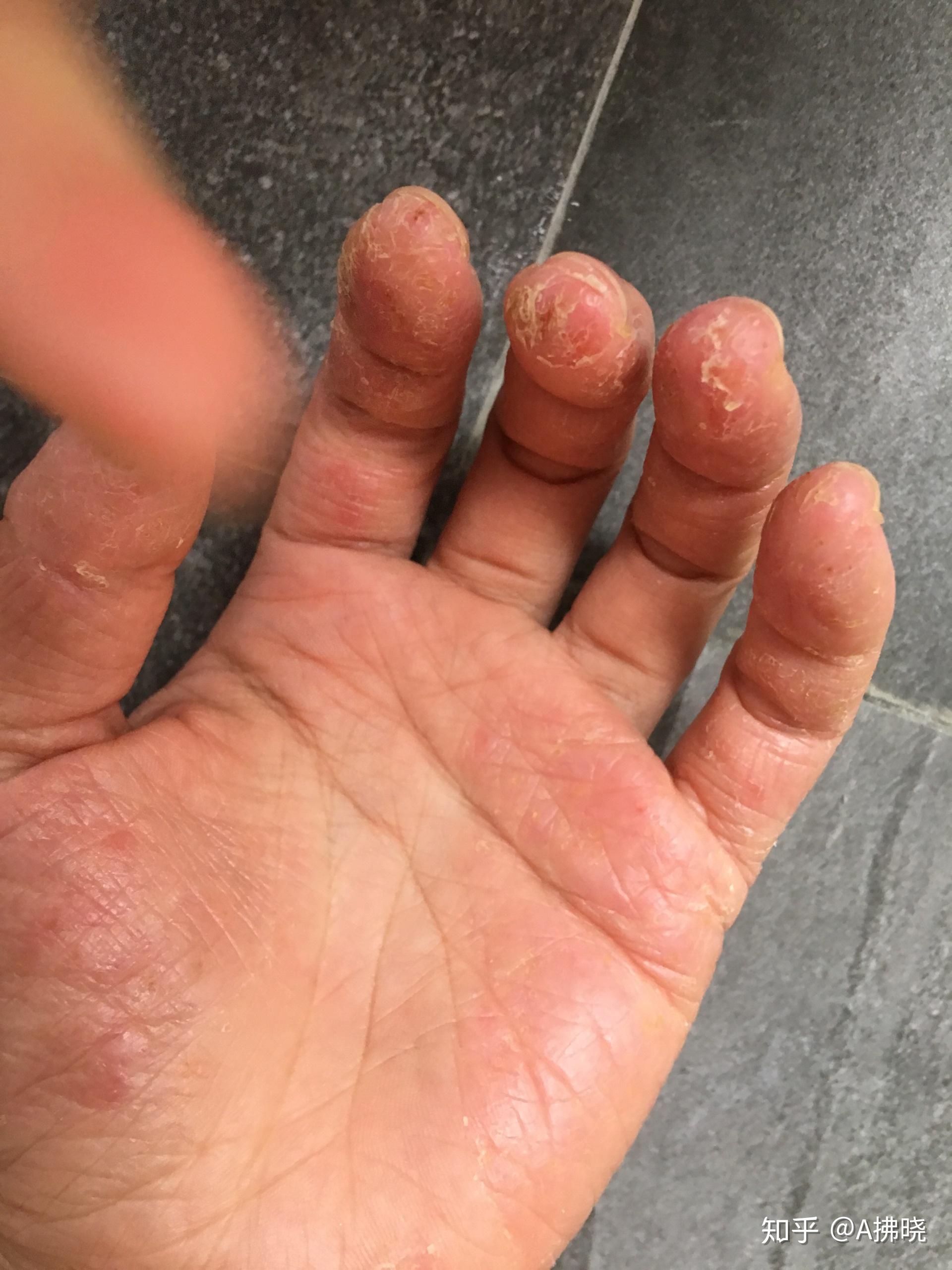 湿疹银行汗疱疹近期治疗效果