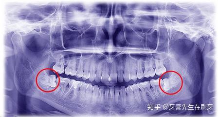 智齒是指人類的第三磨牙,一般在 16～25 歲間萌出,可隨著食物越來越