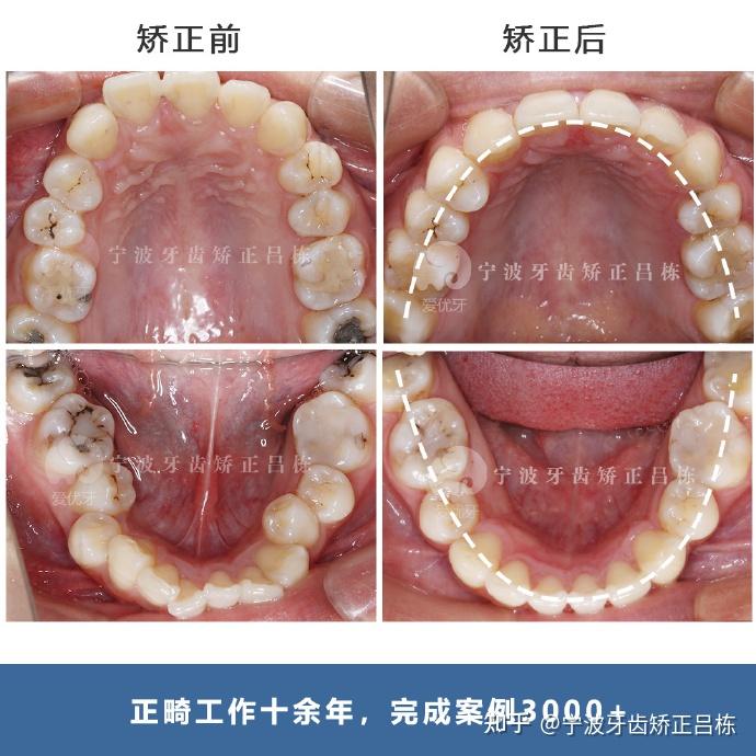 對稱性,拔除了三顆正畸牙,上頜配合平導,打開咬合並且控制磨牙的伸長