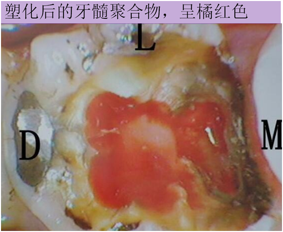 牙髓炎只能做根管治療還有其他方案嗎