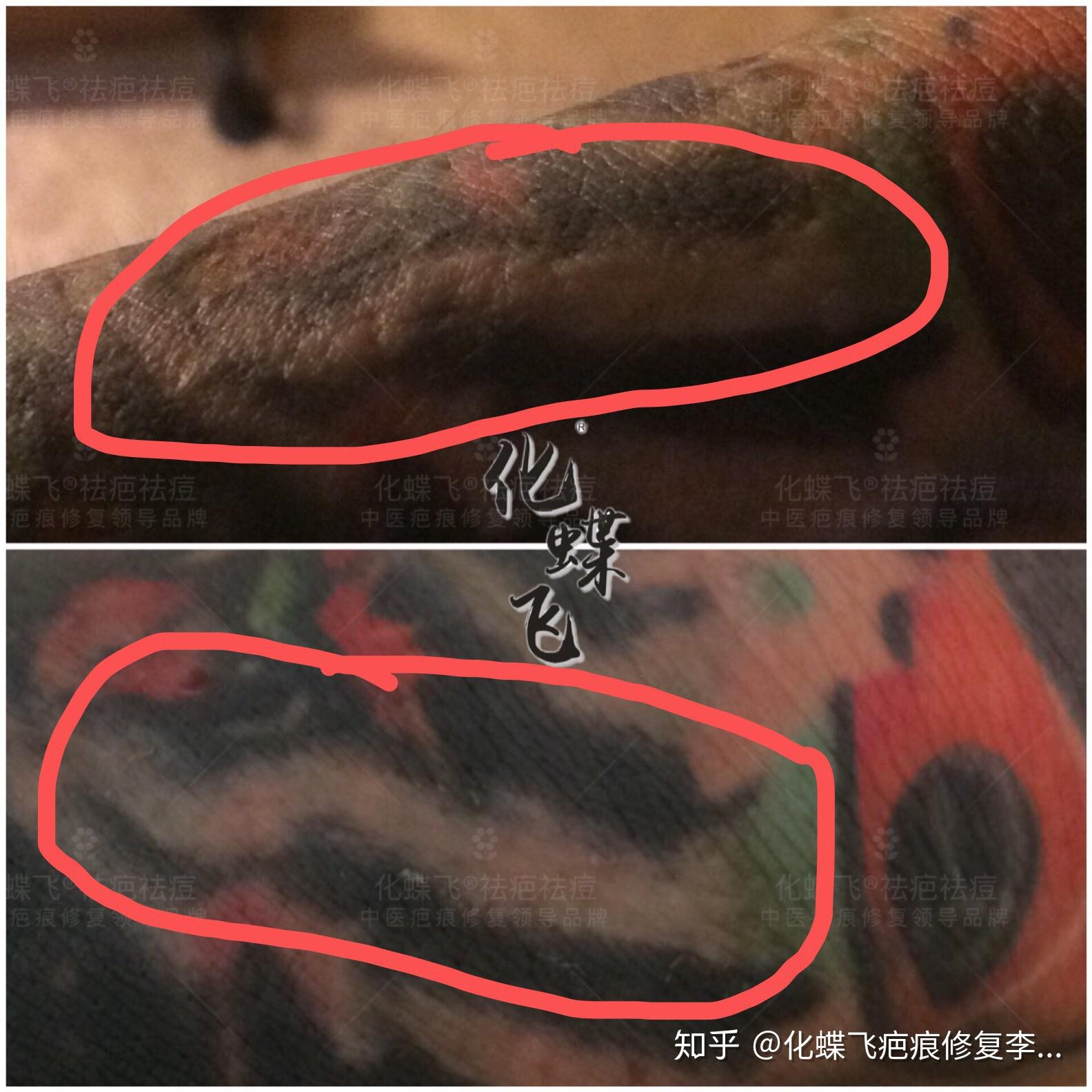 洗紋身留疤了怎麼辦