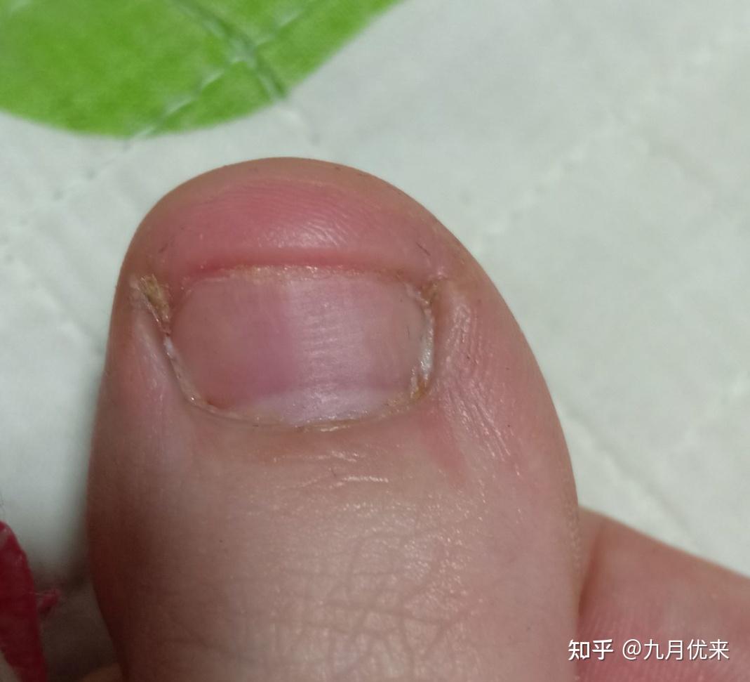 怀孕,哺乳期患上灰指甲怎样根除?会不会传染给宝宝?平时要注意什么?
