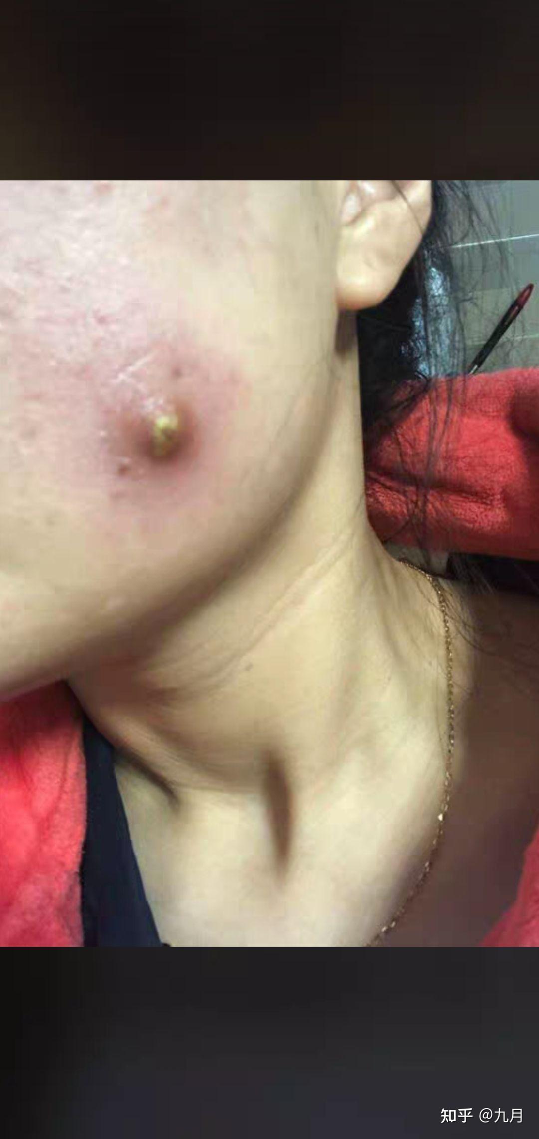 火疖子 皮脂腺囊肿 粉瘤 - 知乎
