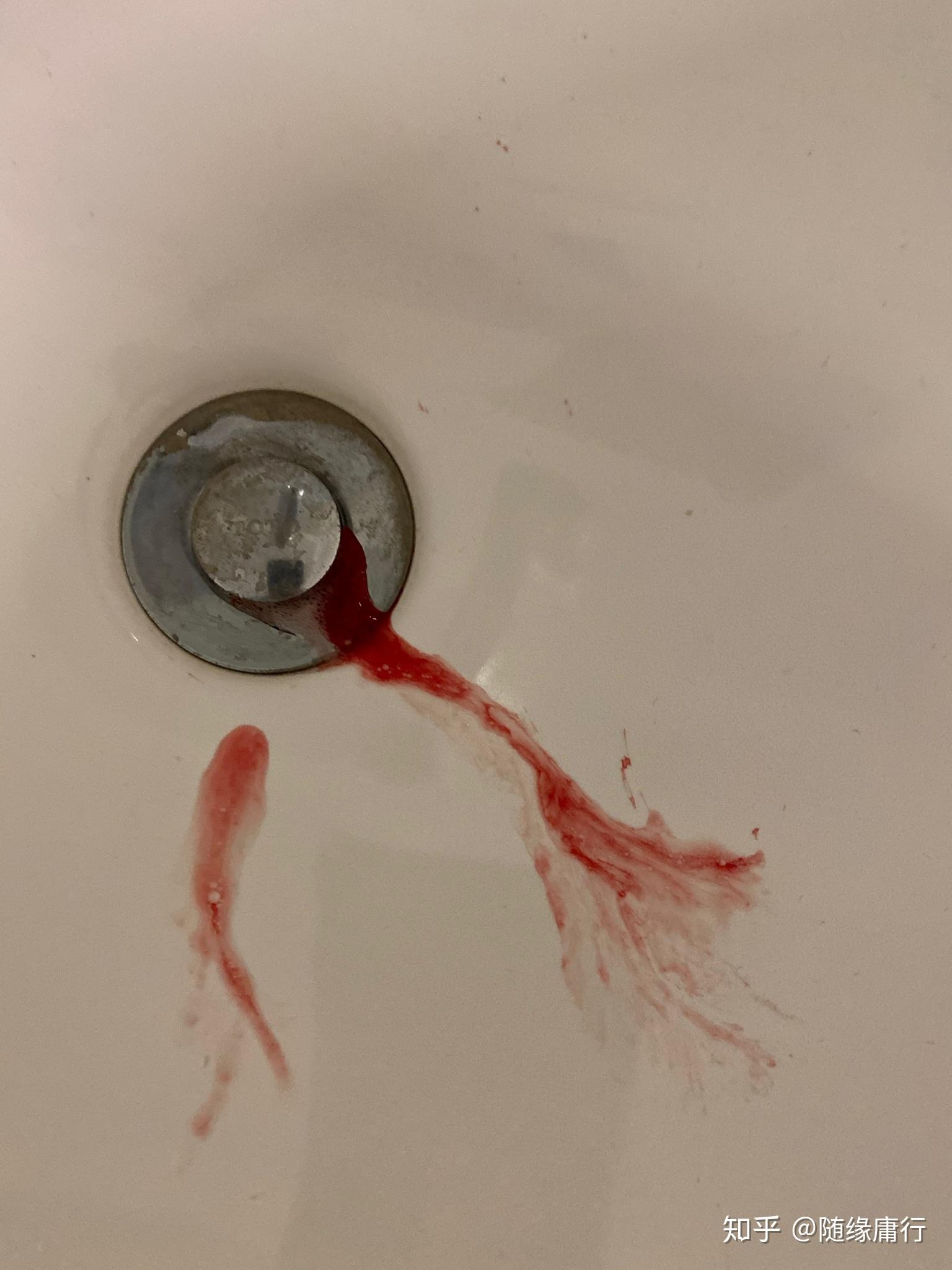 我半夜突然觉得喉咙甜甜的,而且发热,单身吐口水,全是鲜血,吓得我一个