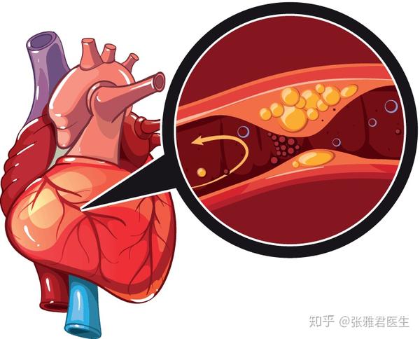 carotid-artery-disease