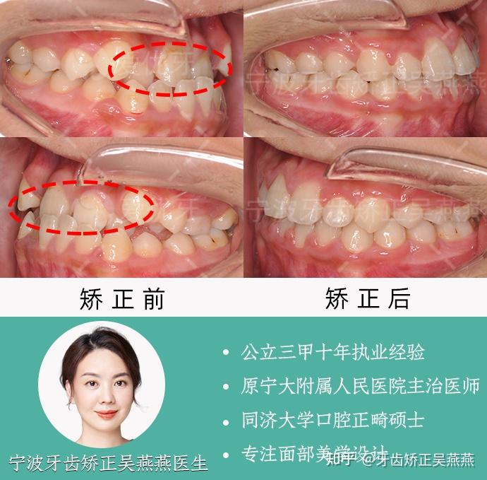宁波牙齿矫正安氏iii类错颌畸形不拔牙实现侧颜蜕变