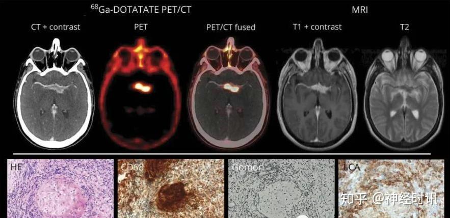 Neurology病例:神经结节病的68Ga-DOTATATE PET/CT先进成像 - 知乎