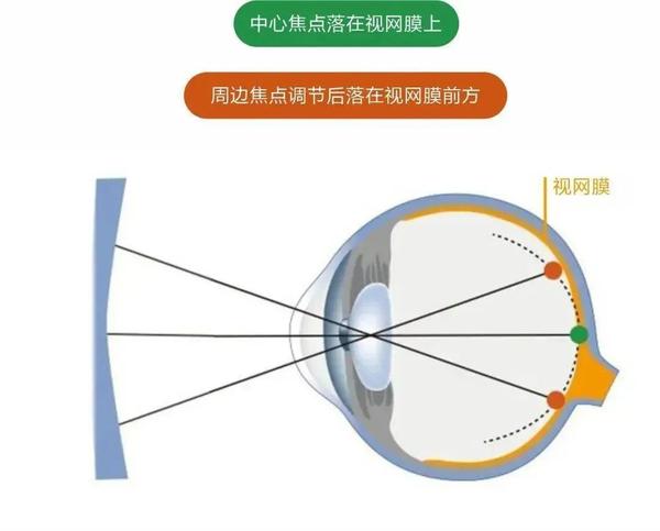 多点离焦眼镜与普通眼镜有何不同? - 知乎