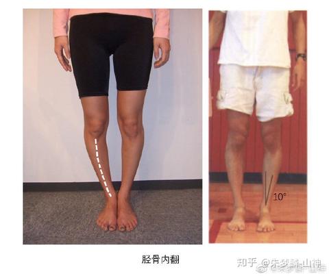 腿型矫正