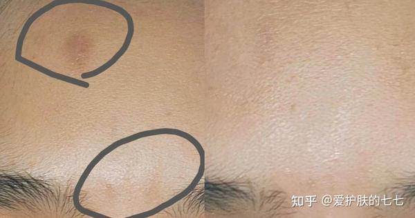 男生满脸痘印究竟怎样才能去掉?皮肤科医生教你科室专用去痘印方法,一个月把痘印去干净!4步搞定! - 知乎