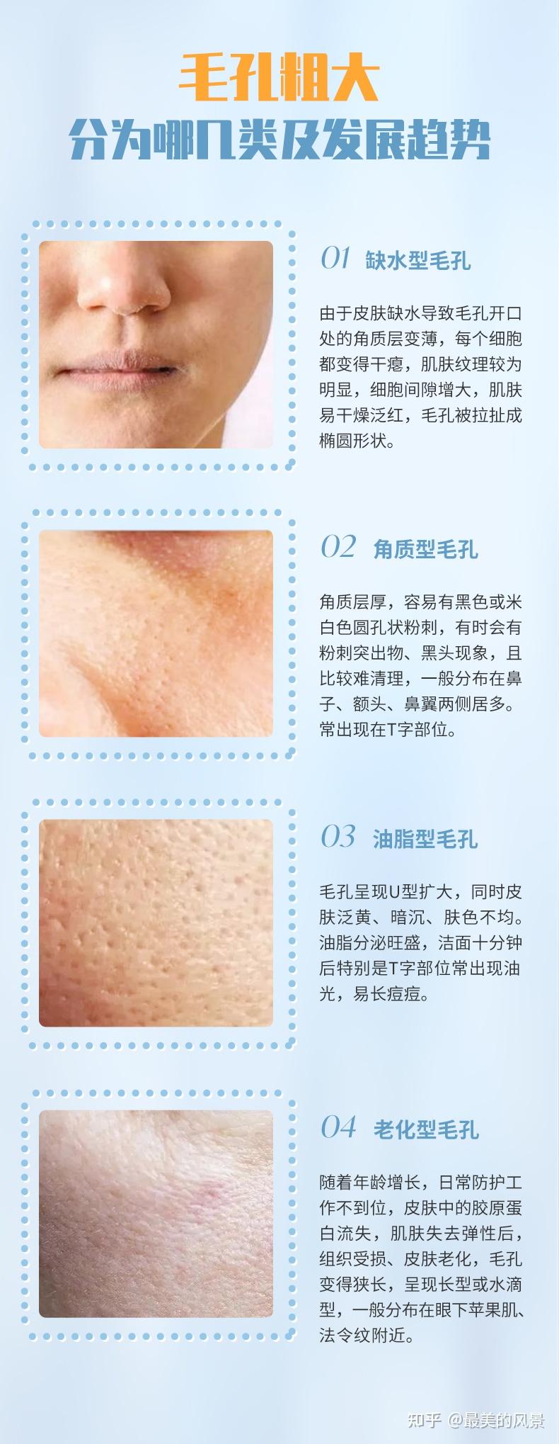 毛孔大得像“筛子”,你的毛孔是怎么一步步撑大的? - 知乎