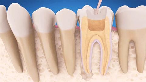 牙疼後為什麼醫生建議你根管治療而不是補牙這裡面有門道