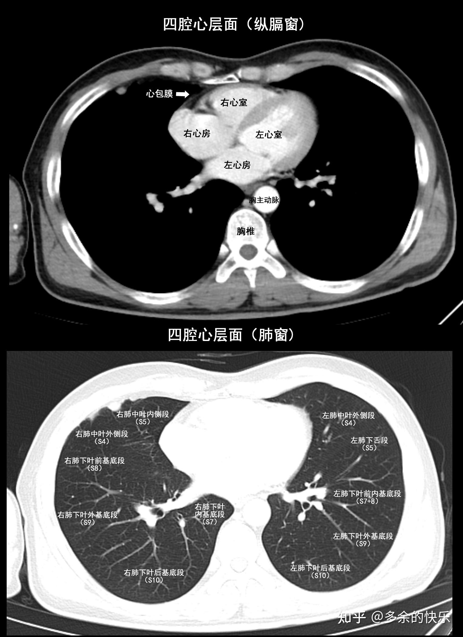 胸腺癌治疗那些事（十四）胸部CT看片入门 - 知乎