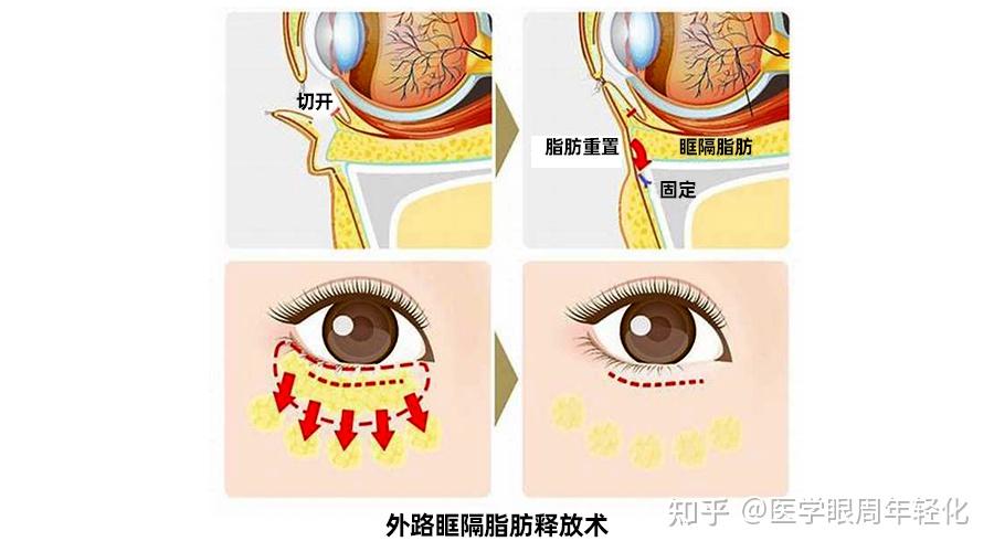 祛眼袋可以做眶隔脂肪释放术吗