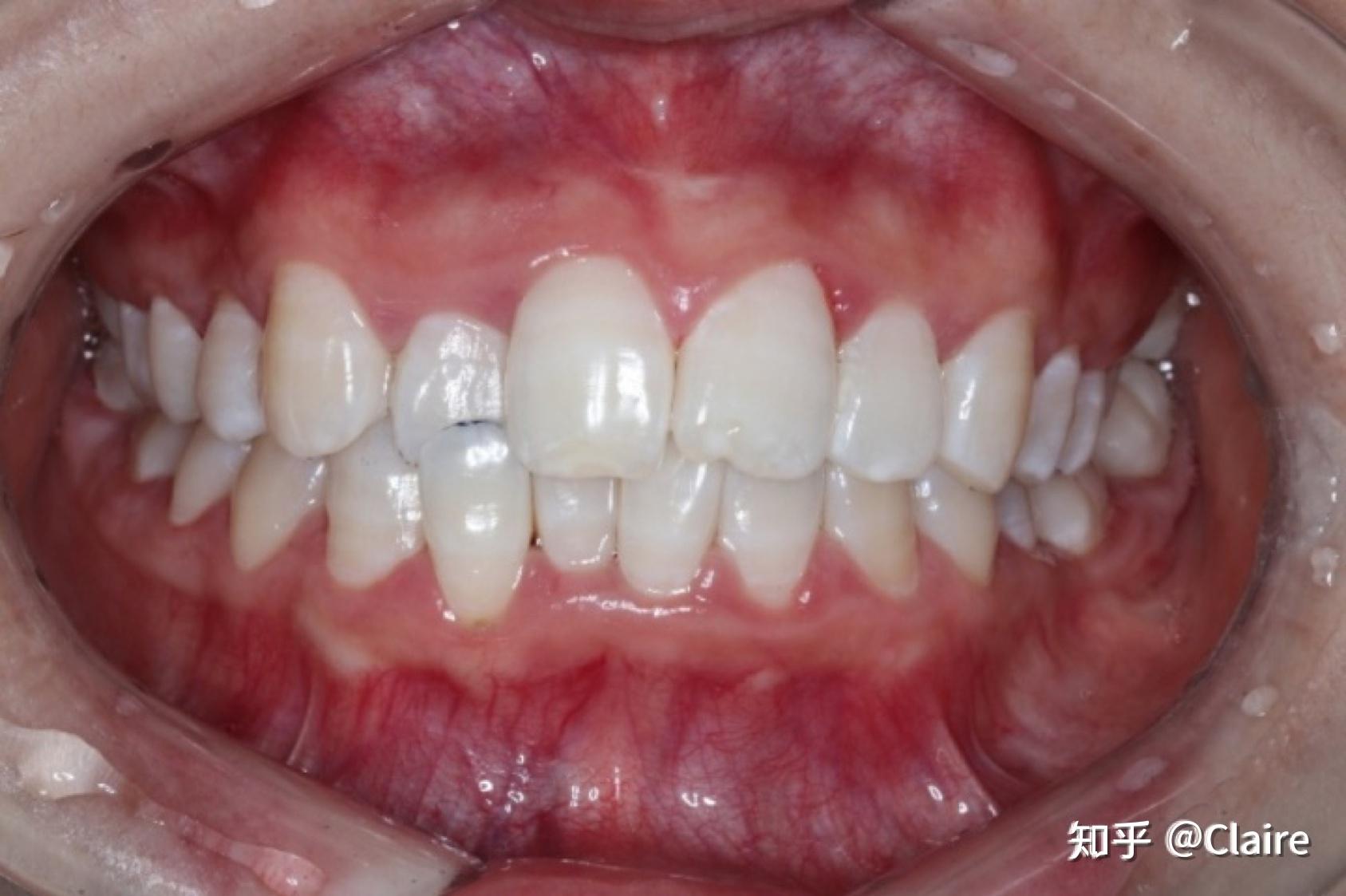 一个趣味实验告诉你，种植牙到底有多坚固_广州德伦口腔