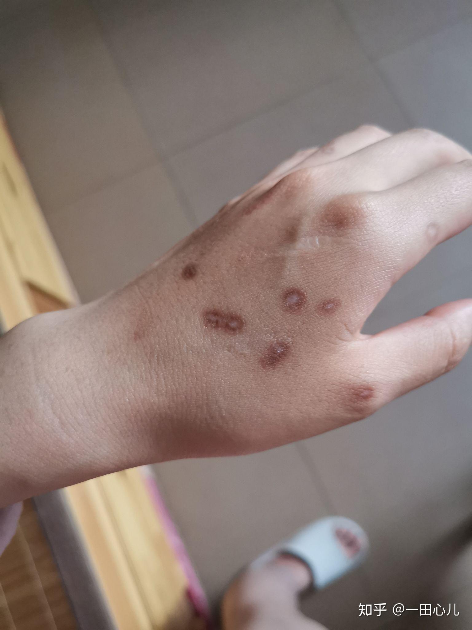 扁平疣冷冻 - 知乎