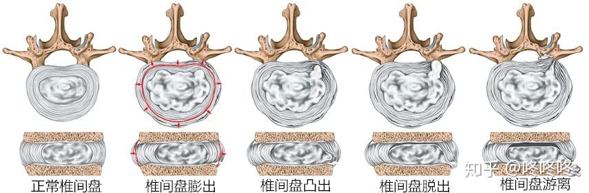 颈椎病初步认识二