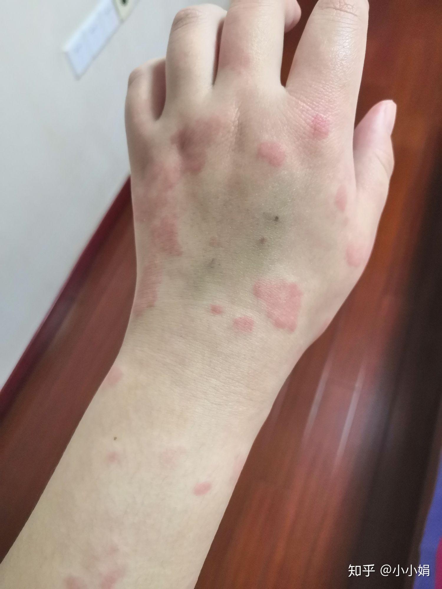 新冠期间遇上了荨麻疹 - 知乎