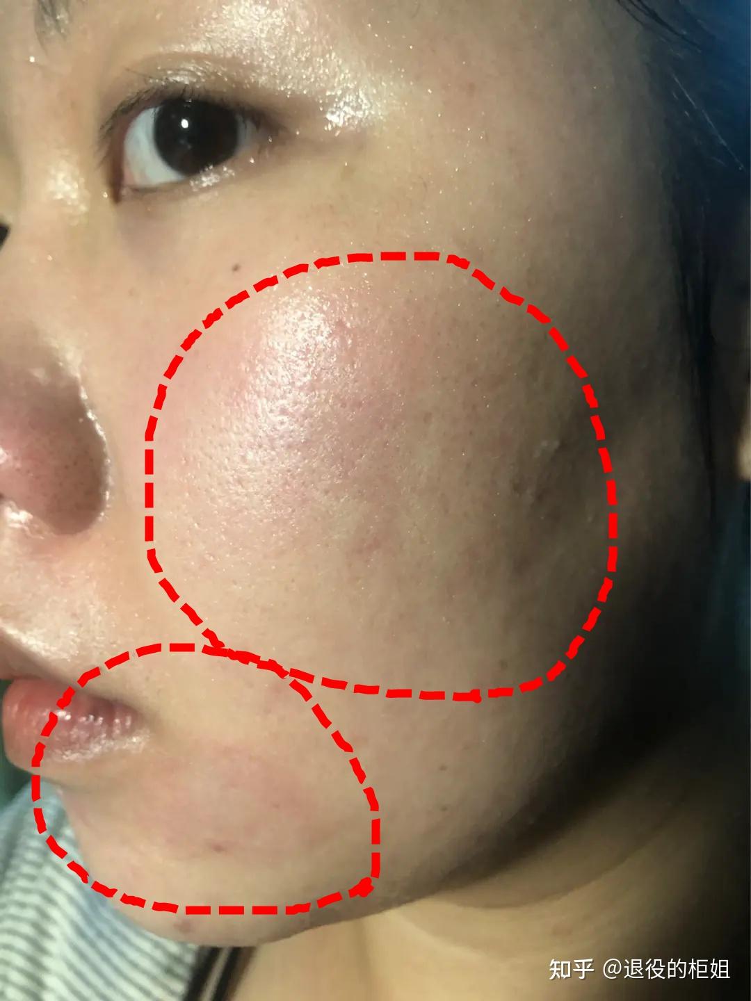 刷酸后为什么会返黑? - 知乎