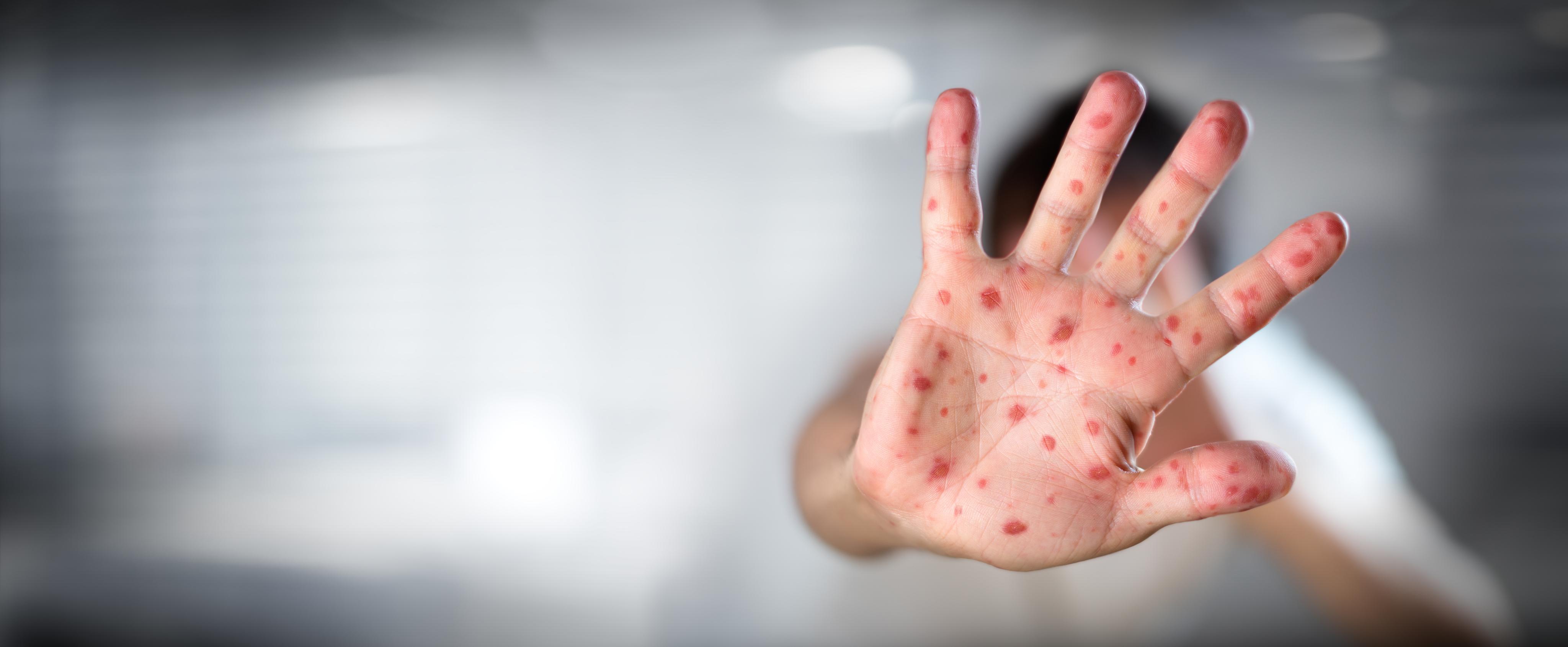 Infectious Diseases A-Z: Protect children from chickenpox infection ...