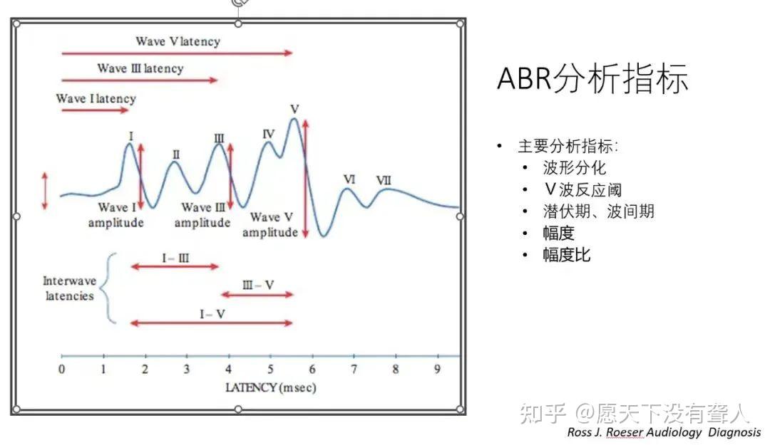 听神经细小系列科普|(二)如何精准诊断听神经细小(听力学特征) - 知乎