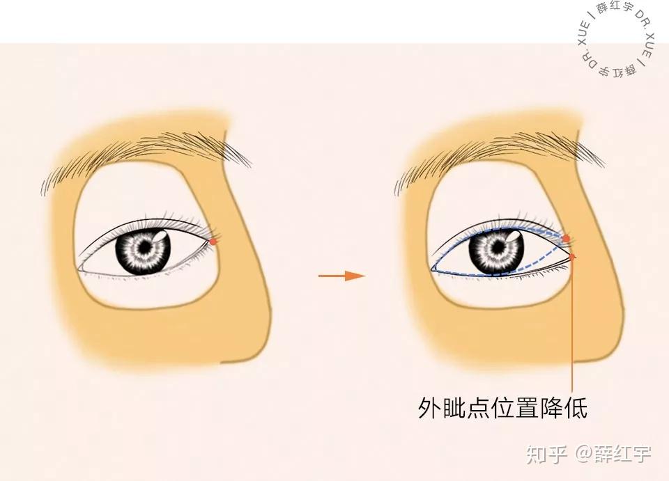 吊眼的外眦角高于内眦角,这种情况开外眼角可以改善吊眼的形态,还能