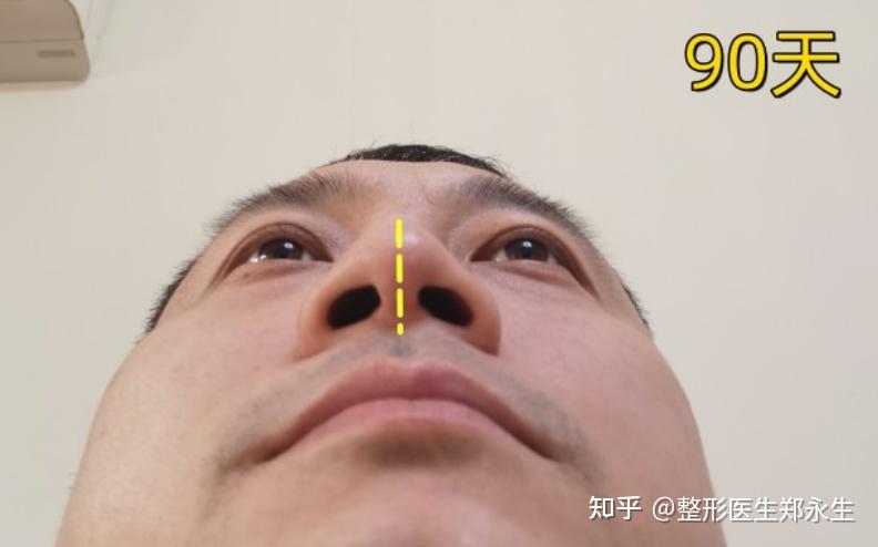 很多人都说鼻中隔偏曲千万不要做手术,为何?医生:原因出在这里 - 知乎