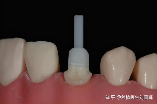 牙齿残根究竟要不要拔?怎么处理影响是最小的? - 知乎