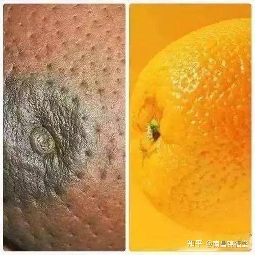 乳腺癌的症状 前期图片