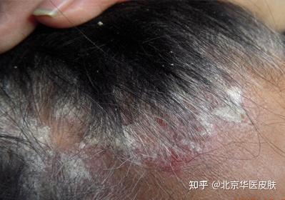脂溢性皮炎 - 知乎