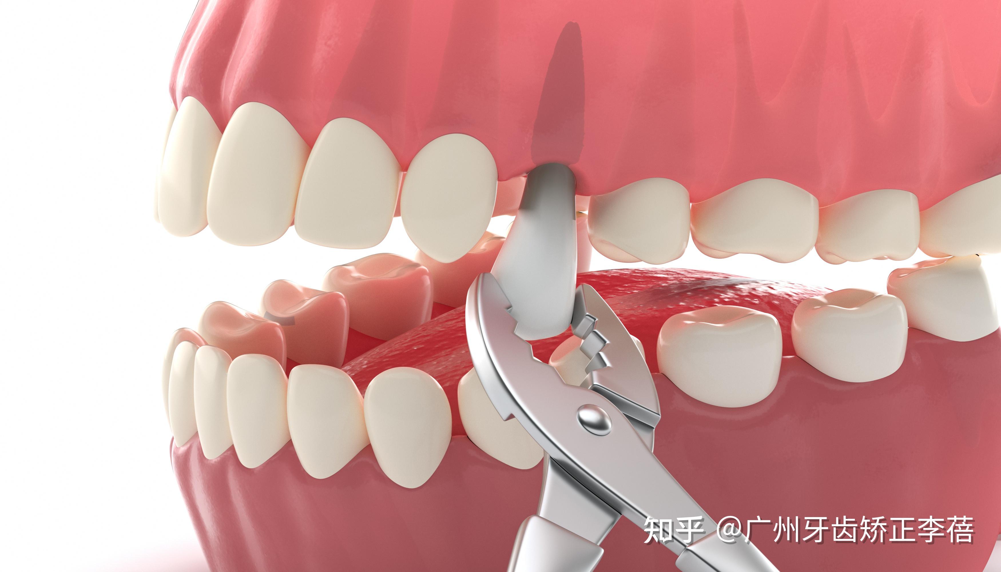 牙医拔牙 为什么牙医总建议拔牙_华夏智能网
