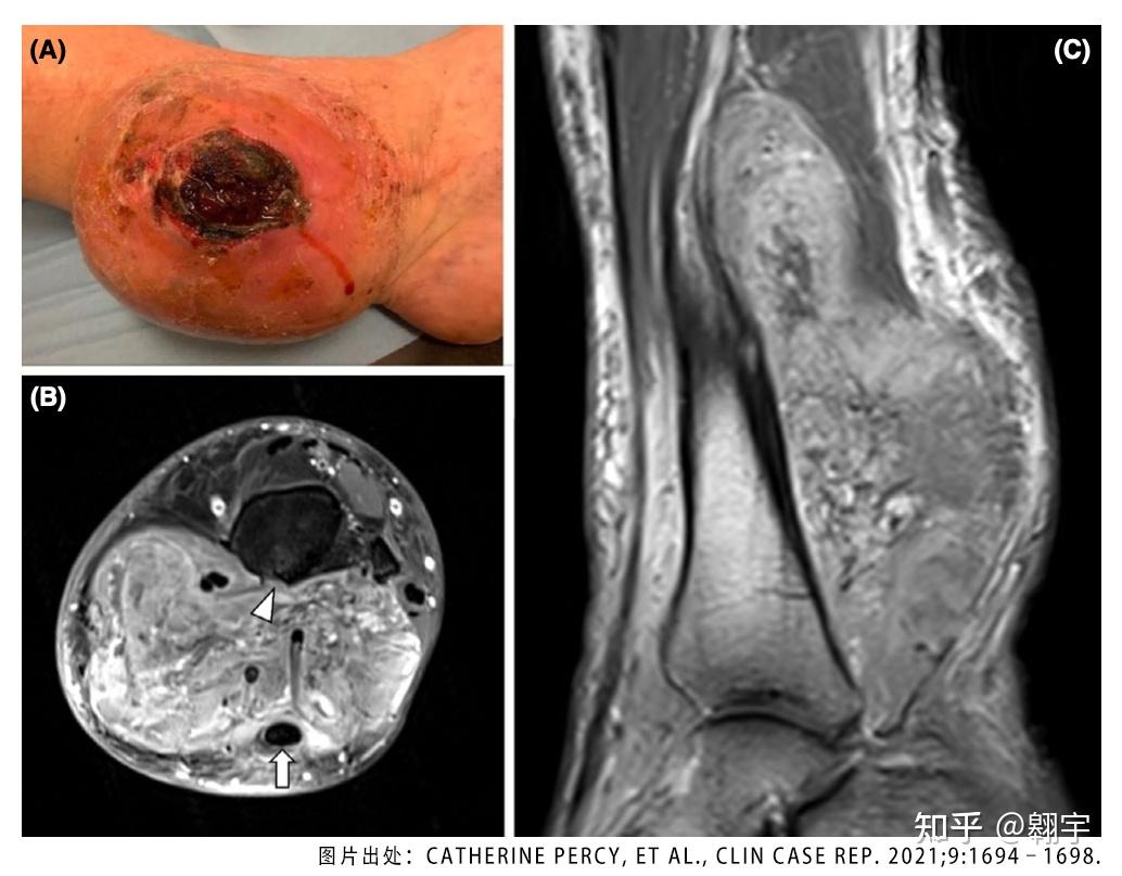 ntrk重排的软组织肉瘤因为这款神奇的靶向药避免了截肢