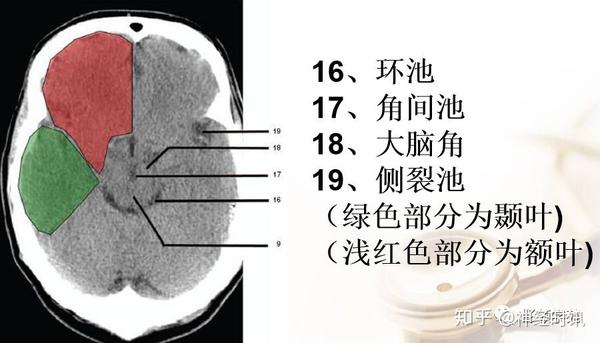 解剖&影像 ~ 脑实质CT断层解剖 - 知乎