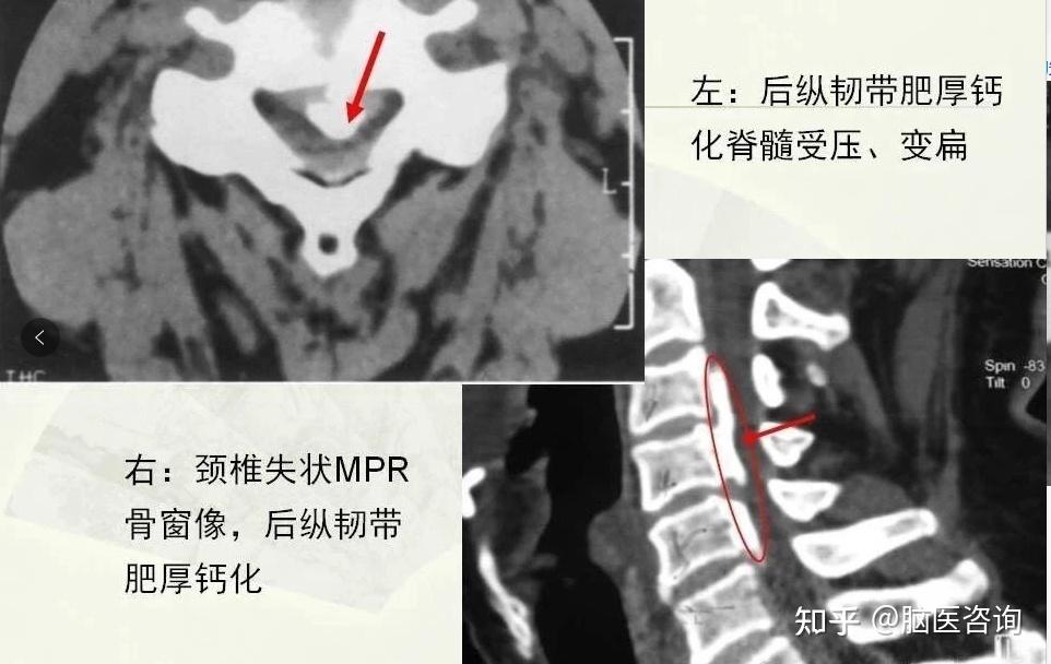 颈椎病拍片子的那些事儿