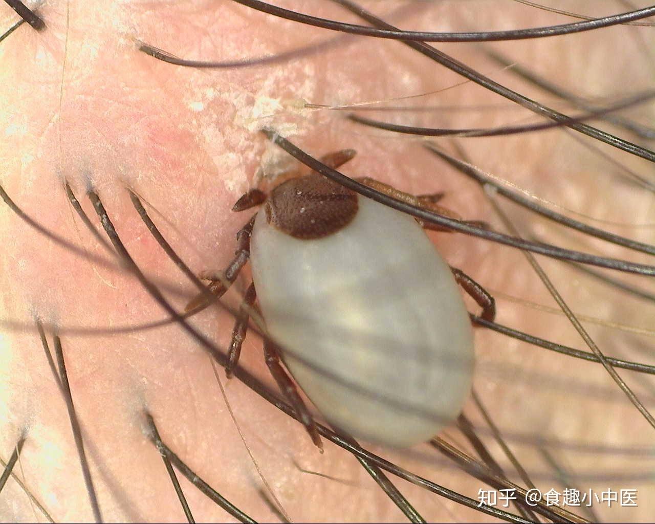 还有一种钻皮肤的昆虫,在中国已被记录的就有100多种——蜱虫