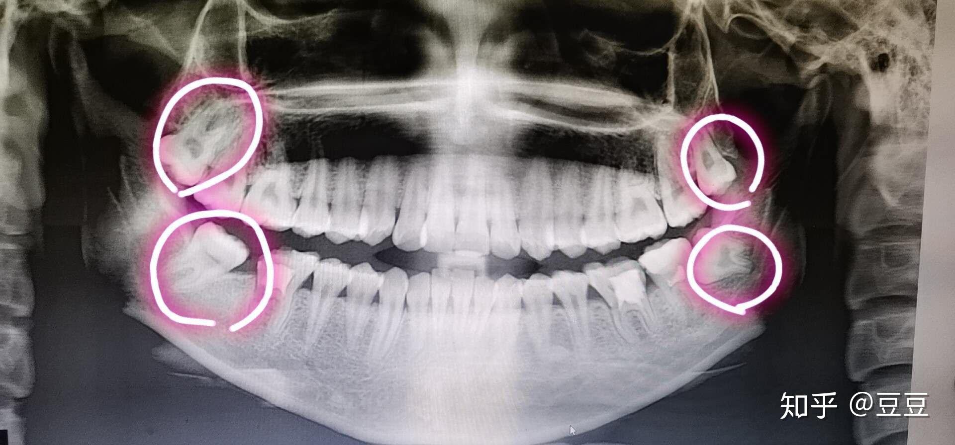 数字化导板在后牙种植中的应用 - 知乎