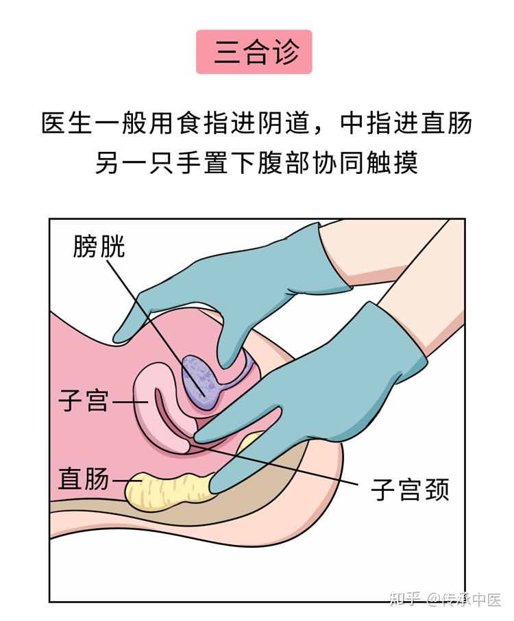 也可以找出子宫肌瘤或卵巢肿瘤可以确定子宫的位置通过两只手的协调较