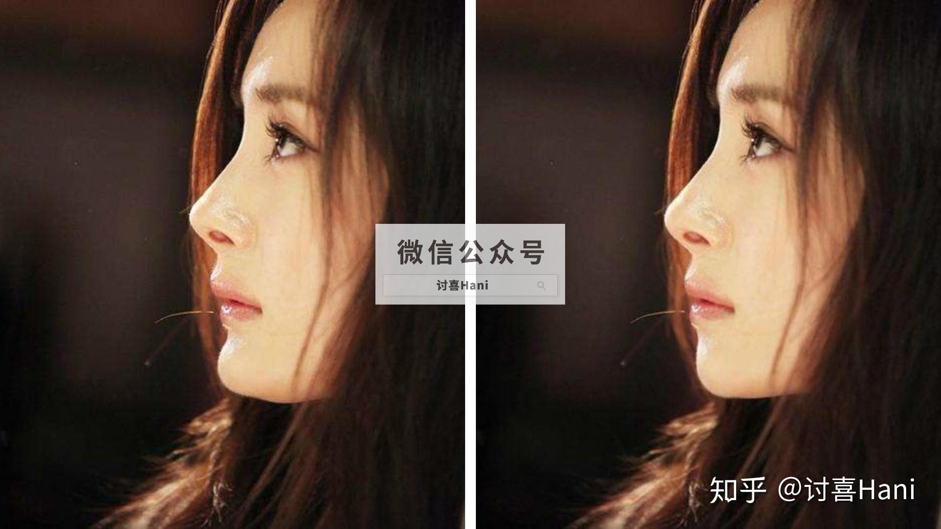 揭秘侧颜瘫脸型真相微凹面型和假凹面型了解一下